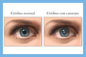 catarata en el ojo a partir de los 40