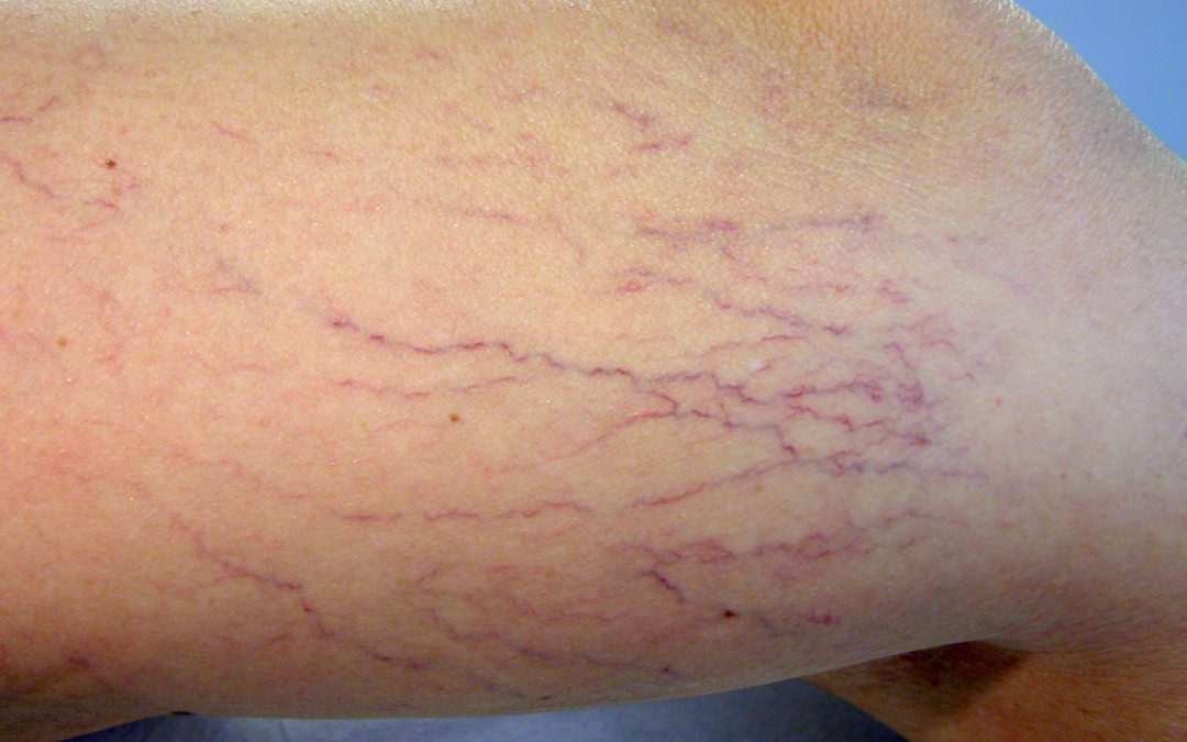 Consejos para decir adiós a las varices
