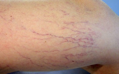 Consejos para decir adiós a las varices